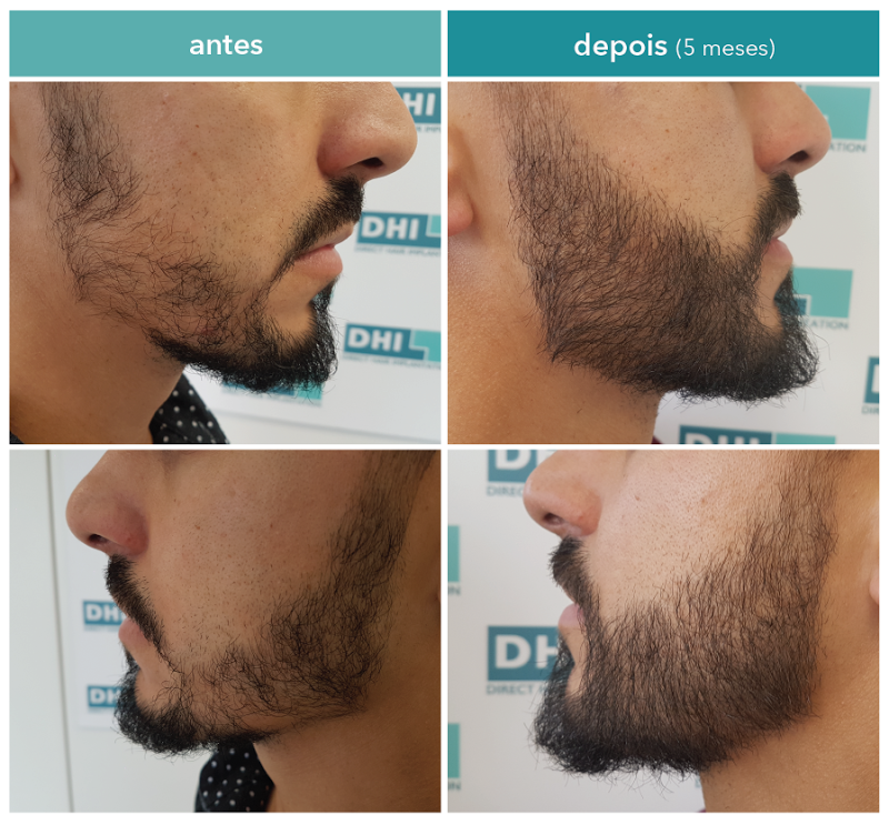 dany fernandes_transplantede barba_dhi_depois5meses-01